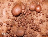 neurofibromatosis