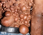 neurofibromatosis