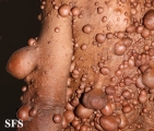 neurofibromatosis