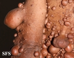 neurofibromatosis