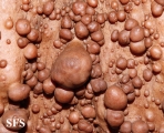 neurofibromatosis