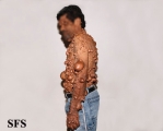neurofibromatosis