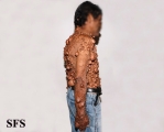 neurofibromatosis