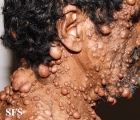 neurofibromatosis