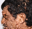 neurofibromatosis