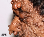 neurofibromatosis