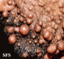 neurofibromatosis