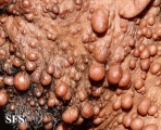 neurofibromatosis
