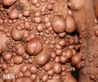 neurofibromatosis