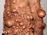 neurofibromatosis