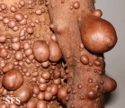 neurofibromatosis
