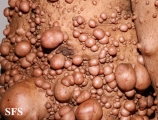 neurofibromatosis