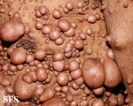 neurofibromatosis