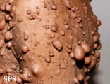 neurofibromatosis
