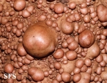 neurofibromatosis