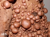neurofibromatosis