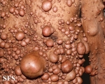 neurofibromatosis