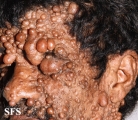 neurofibromatosis