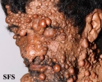 neurofibromatosis