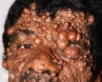 neurofibromatosis