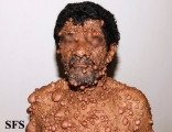 neurofibromatosis