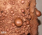neurofibromatosis