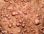 neurofibromatosis