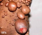 neurofibromatosis