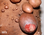 neurofibromatosis