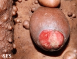 neurofibromatosis