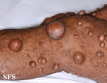 neurofibromatosis