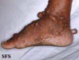 neurofibromatosis