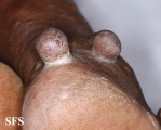 neurofibromatosis