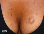 neurofibromatosis