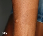 neurofibromatosis