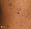 neurofibromatosis