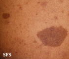 neurofibromatosis