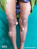 neurofibromatosis