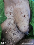 neurofibromatosis