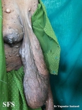 neurofibromatosis