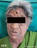 neurofibromatosis