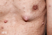 neurofibromatosis