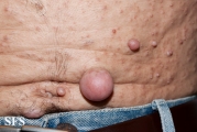 neurofibromatosis