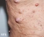 neurofibromatosis