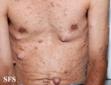 neurofibromatosis