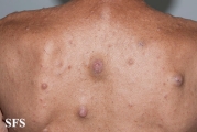 neurofibromatosis