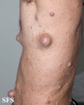 neurofibromatosis