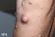 neurofibromatosis