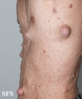 neurofibromatosis