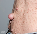 neurofibromatosis